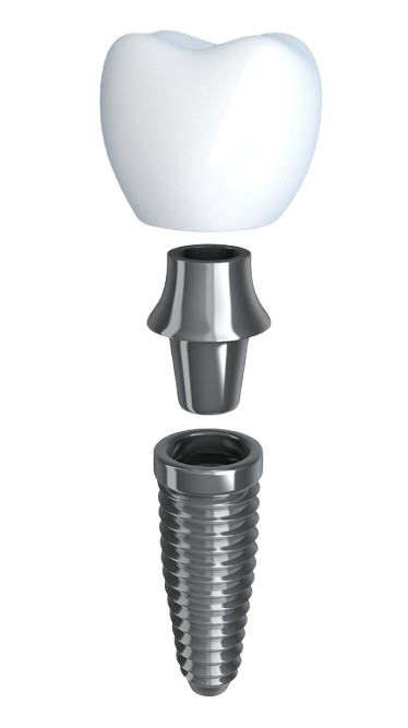 Dental Implant Dentistry Dentures PNG Free Download removebg preview