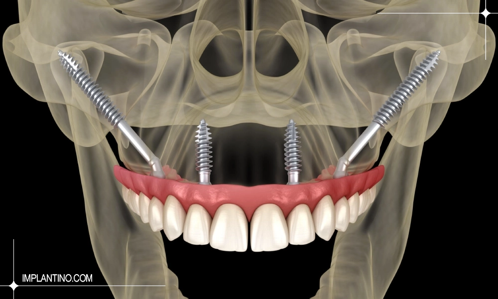ایمپلنت زیگوماتیک (zygomatic) 1 تصویر یه بعدی قرار گیری ایمپلنت زیگوماتیک از نمای رو به روی صورت