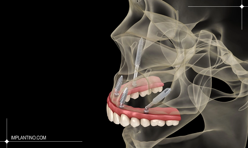 ایمپلنت زیگوماتیک (zygomatic) 3 تصویر سه بعدی ایمپلنت زیگوماتیک از نمای بغل