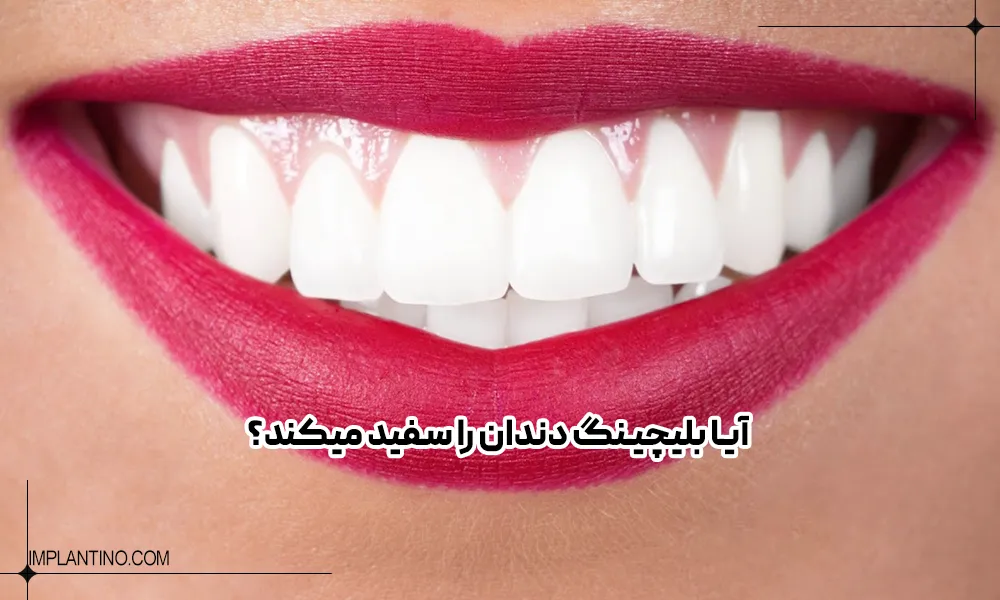 بلیچینگ دندان 3 دندان های خانمی که بعد از بلیچینک دندان سفید شده و در حال لبخند زدن است.