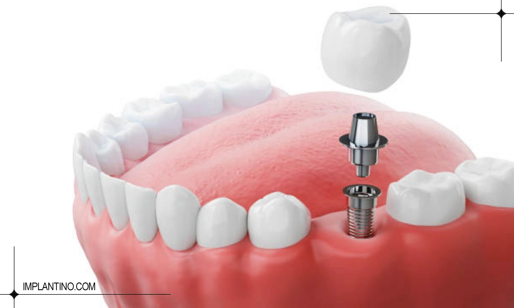 طریقه قرار دادن ایمپلنت فوری بر روی فک پایین