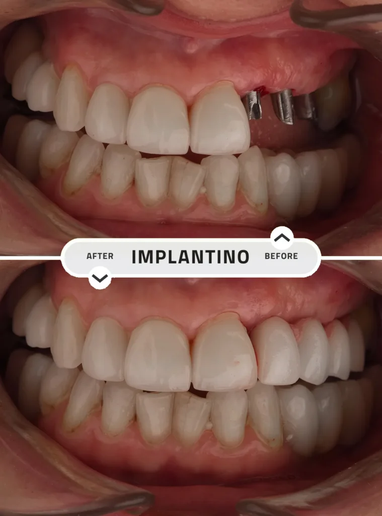 Before-and-after-5-dental-implants-in-the-upper-left-jaw