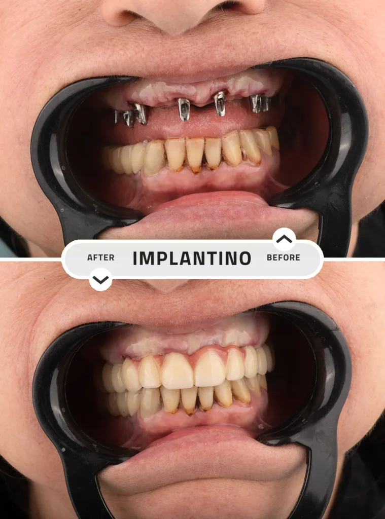 Before-and-after-maxillary-dental-implants