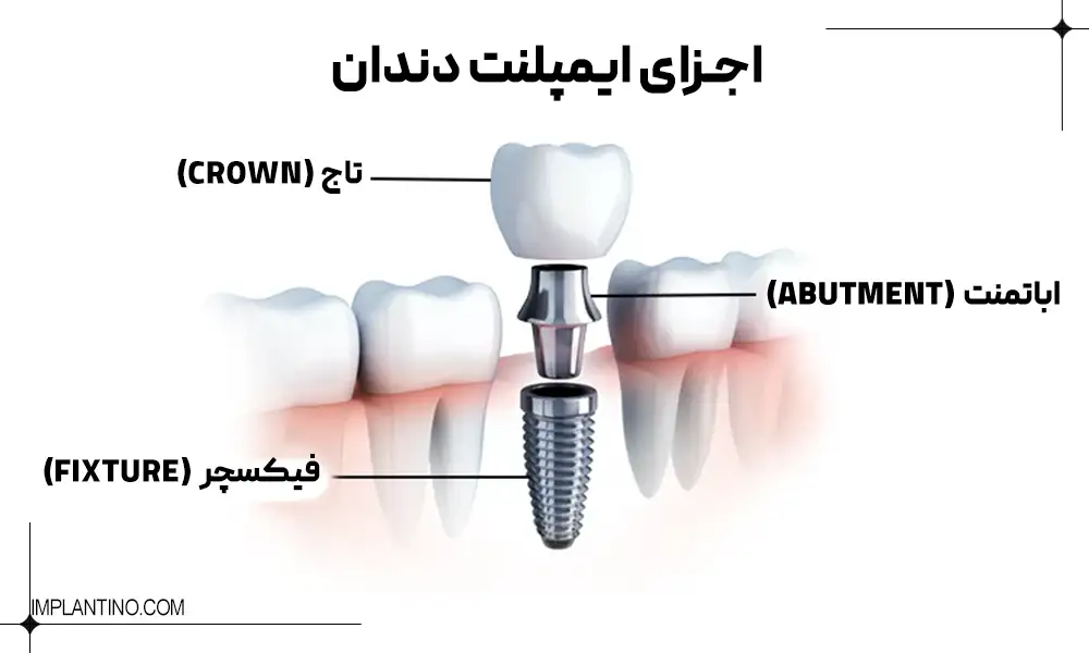عکس اجزا و قطعات ایمپلنت دندان