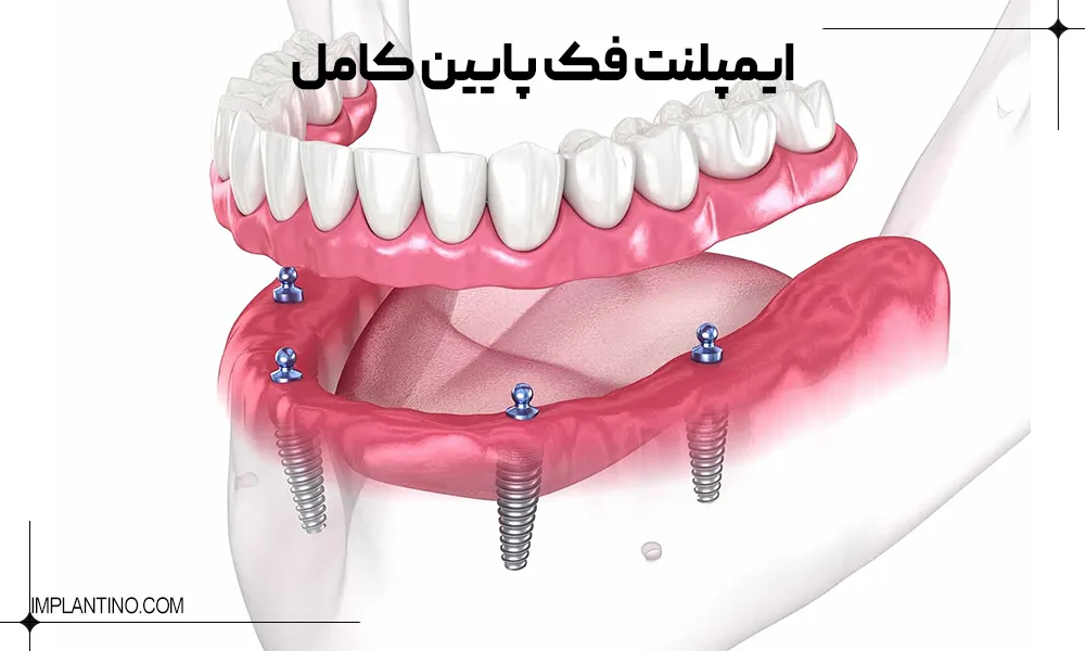 ایمپلنت فول فک / ایمپلنت فول موس 3 ایمپلنت فک پایین کامل