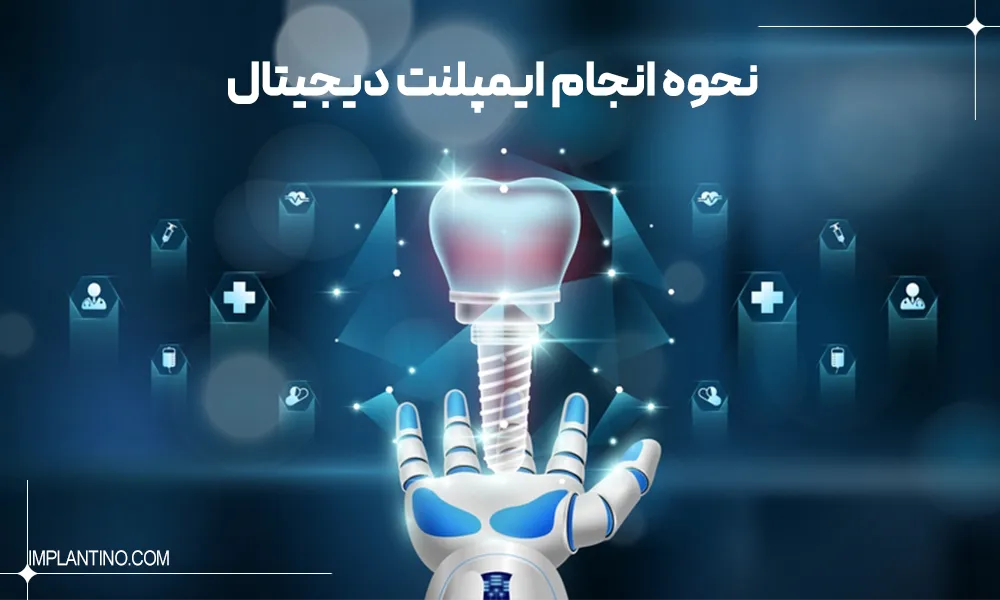 آموزش نحوه انجام ایمپلنت دیجیتال