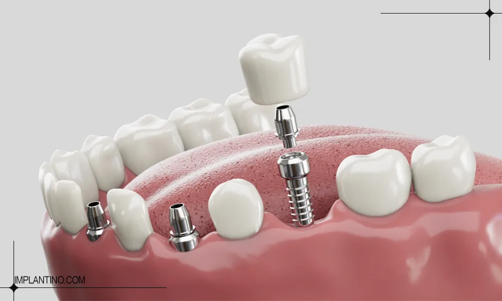 ایمپلنت روی ریشه های دندان