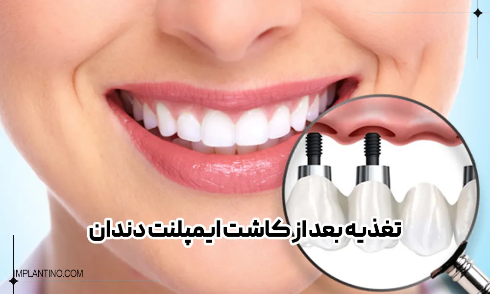 لبخند خانمی که دندان های جلو خود را ایمپلنت کرده است.
