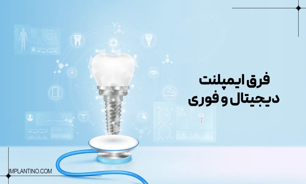 آشنایی با تفاوت ایمپلنت دیجیتال و فوری