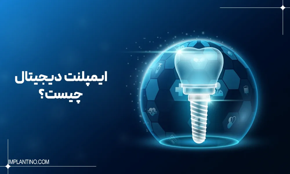 ایمپلنت دیجیتال دندان چیست و چگونه انجام می شود؟