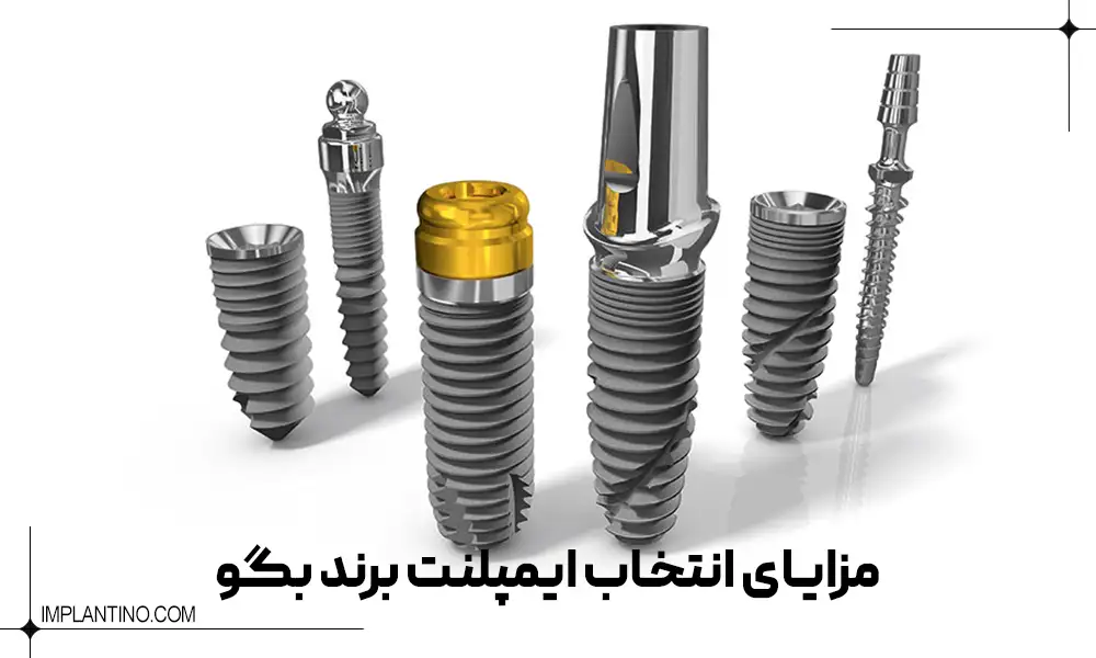 ایمپلمت بگو المان و مزایای آن