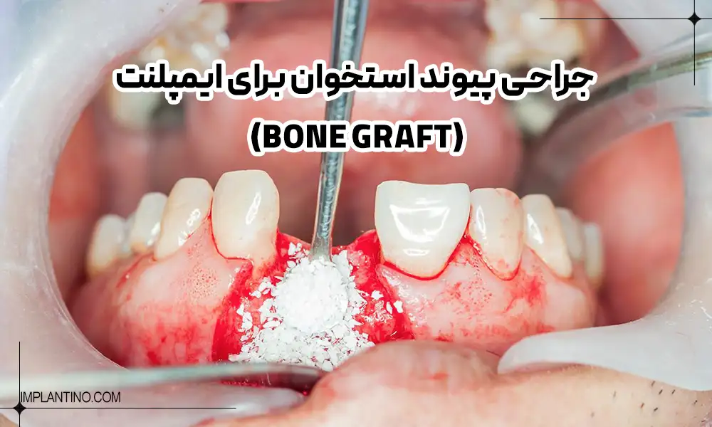 عمل پیوند استخوان برای ایمپلنت دندان یا Bone Graft