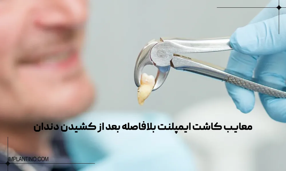 فاصله بین کشیدن دندان و ایمپلنت چقدر است؟ 4 دندان کشیده شده در گیره پزشک و انجام مقدمات کاشت ایمپلنت