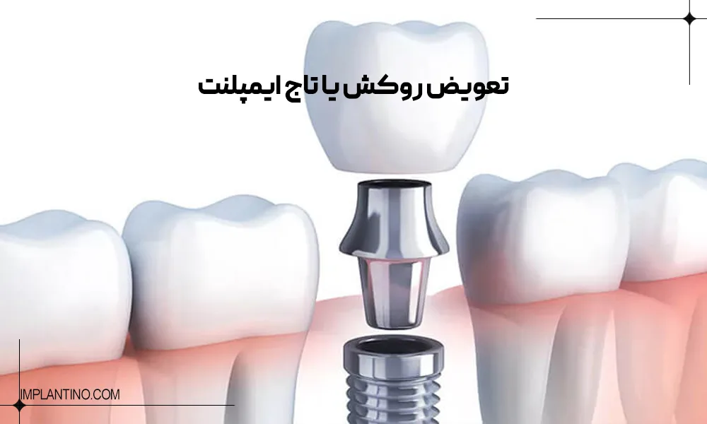 تعویض روکش ایمپلنت چه زمانی باید انجام شود؟ 1 عکس تعویض روکش ایمپلنت