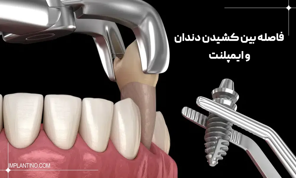 فاصله بین کشیدن دندان و ایمپلنت چقدر است؟ 1 نحوه کشیدن دندان و کاشت ایمپلنت