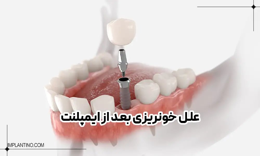 قراردادن ایمپلنت در فک پایین | خونریزی بعد ایمپلنت