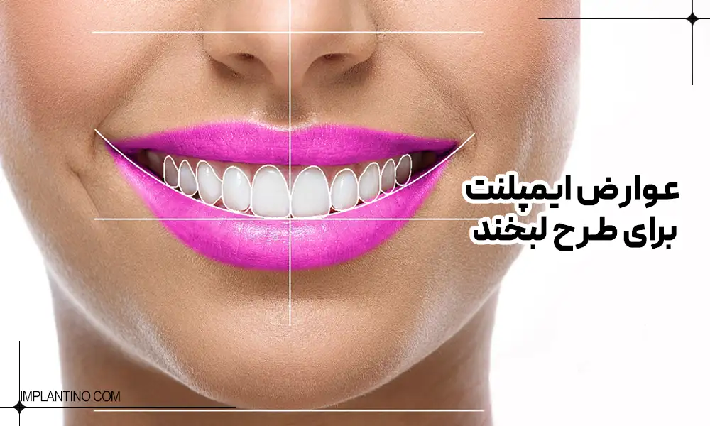 دندان های زیبای یک خانم که با ایمپلنت طرح لبخند زیبایی را به لب آورده