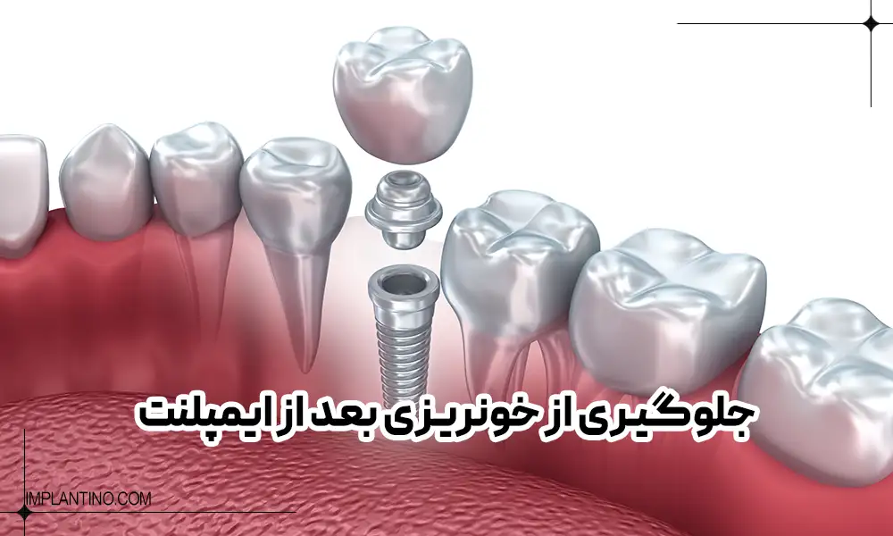 Preventing bleeding after implants