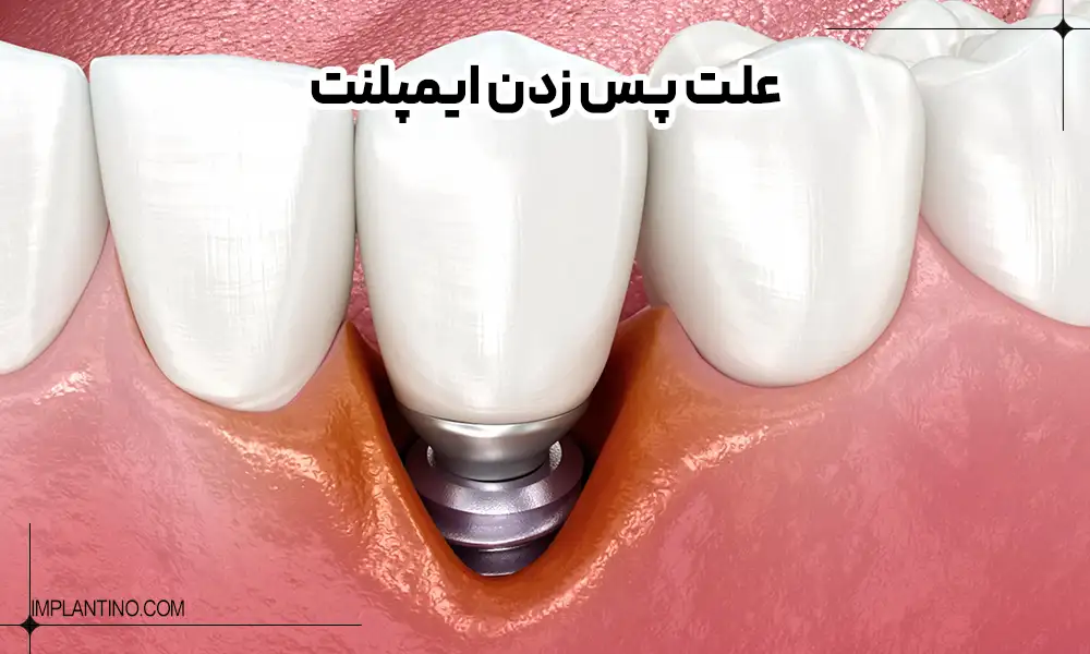دلیل پس زدن ایمپلنت چیست؟ 1 عکس پس زدن ایمپلنت و باز شدن لثه و نمایان شدن ایمپلنت