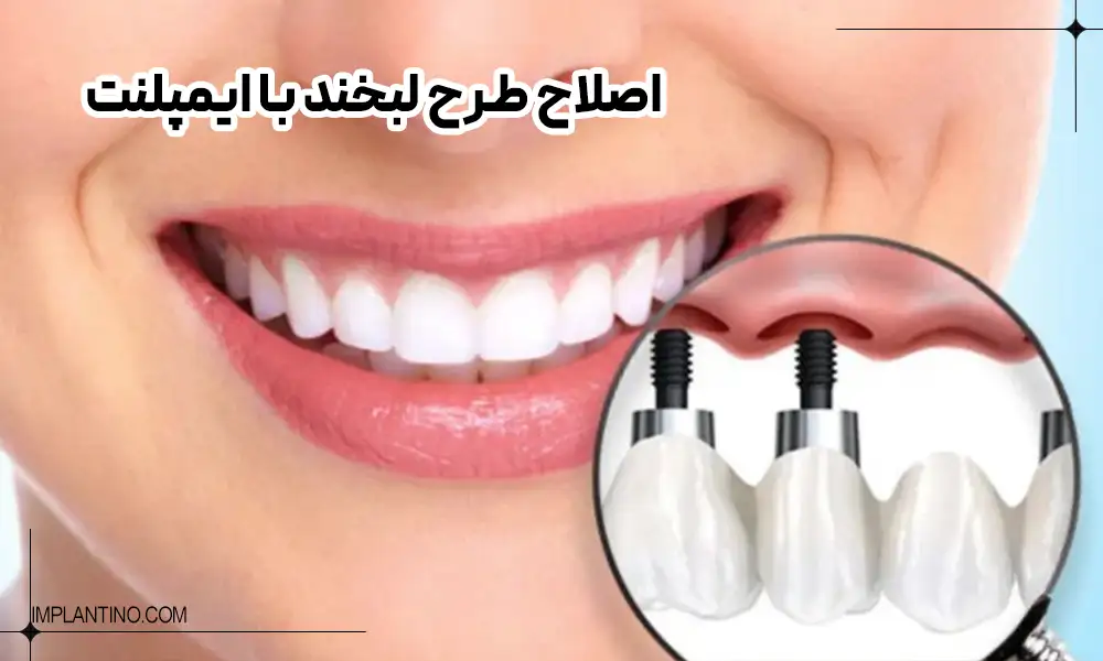 اصلاح دندان های یک خانم با ایمپلنت طرح لبخند