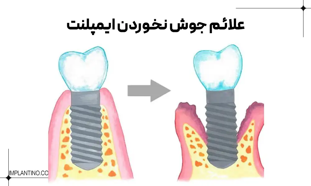 دلیل پس زدن ایمپلنت چیست؟ 2 عکس قیبل و بعد پس زدن ایمپلنت دندان