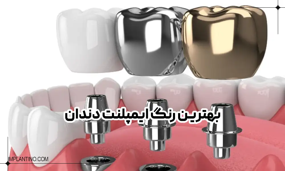رنگ ایمپلنت دندان