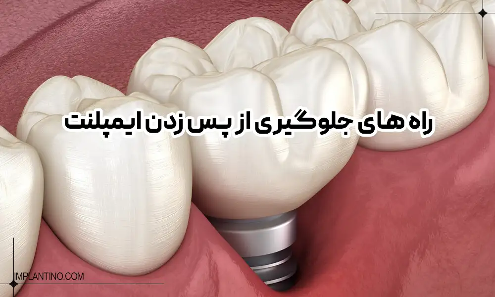 دلیل پس زدن ایمپلنت چیست؟ 3 پیدا شدن ایمپلنت بعد از پس زدن ایمپلنت