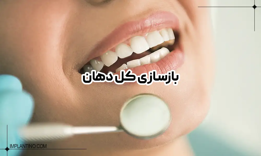 بازسازی کامل دهان و دندان با روش های دندانپزشکی 1 بازسازی کامل دهان و دندان برای یک خانم