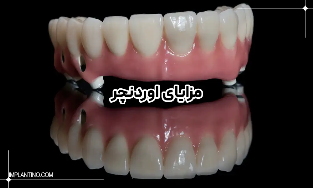 اوردنچر 2 شکل اوردنچر