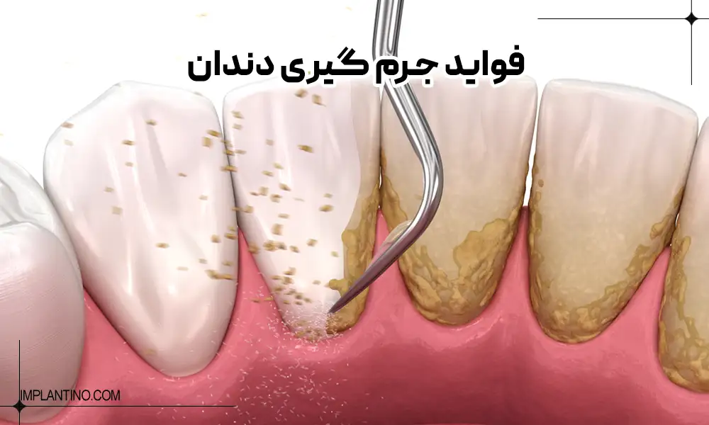 عکس نحوه جرم گیری دندان
