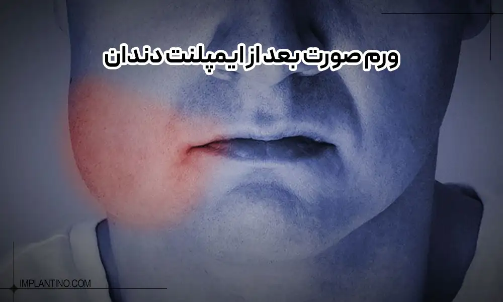 چگونه ورم بعد از ایمپلنت دندان را درمان کنیم؟ 1 صورت ورم کرده بک آقا | ورم بعد از ایمپلنت دندان
