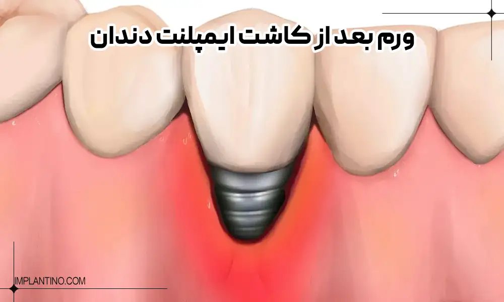 چگونه ورم بعد از ایمپلنت دندان را درمان کنیم؟ 4 عکس ورم بعد از ایمپلنت دندان