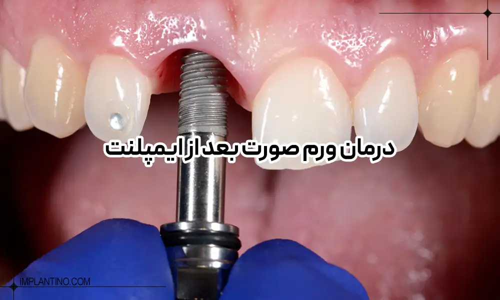 چگونه ورم بعد از ایمپلنت دندان را درمان کنیم؟ 3 قرار دادن ایمپلنت در لثه | ورم بعد از ایمپلنت دندان