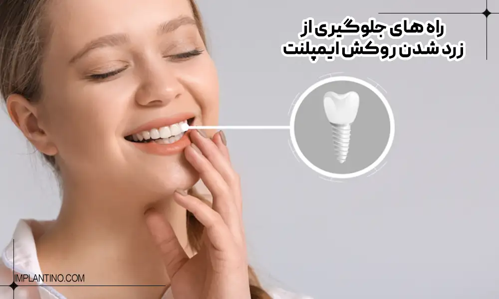 نمایش سفید کردن ایمپلنت دندان