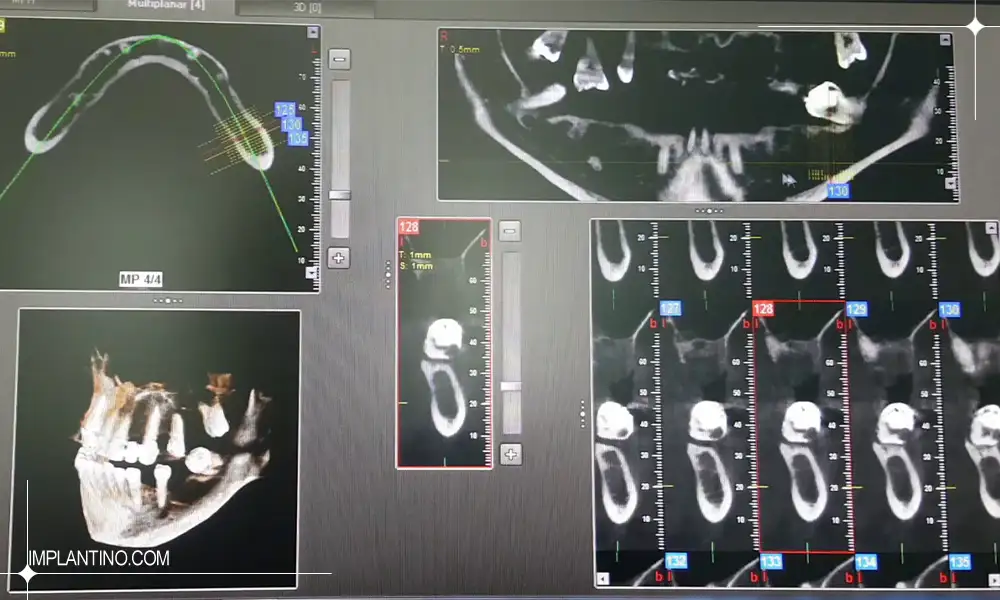 مدل عکس CBCT