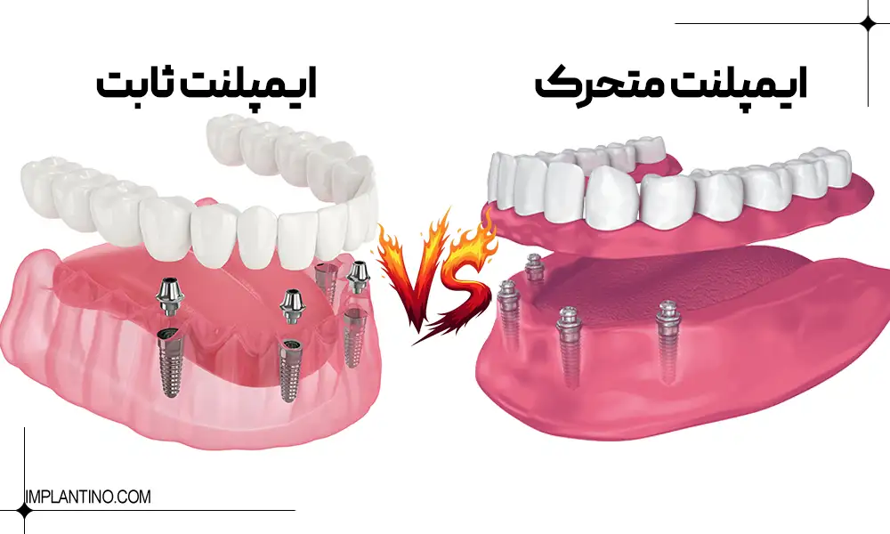 عکس ایمپلنت ثابت و متحرک