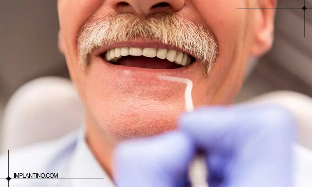 ایمپلنت در سن بالا ضرر دارد یا خیر ؟ 1 عکس آقایی بعد از انجام ایمپلنت در سن بالا